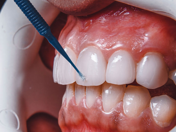 Blanqueamiento Dental en Maturin